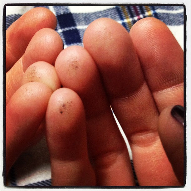 Fingers of A Diabetic -- ouch